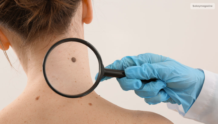 How To Know If A Mole Is Cancerous