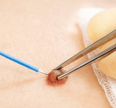 Mole Removal