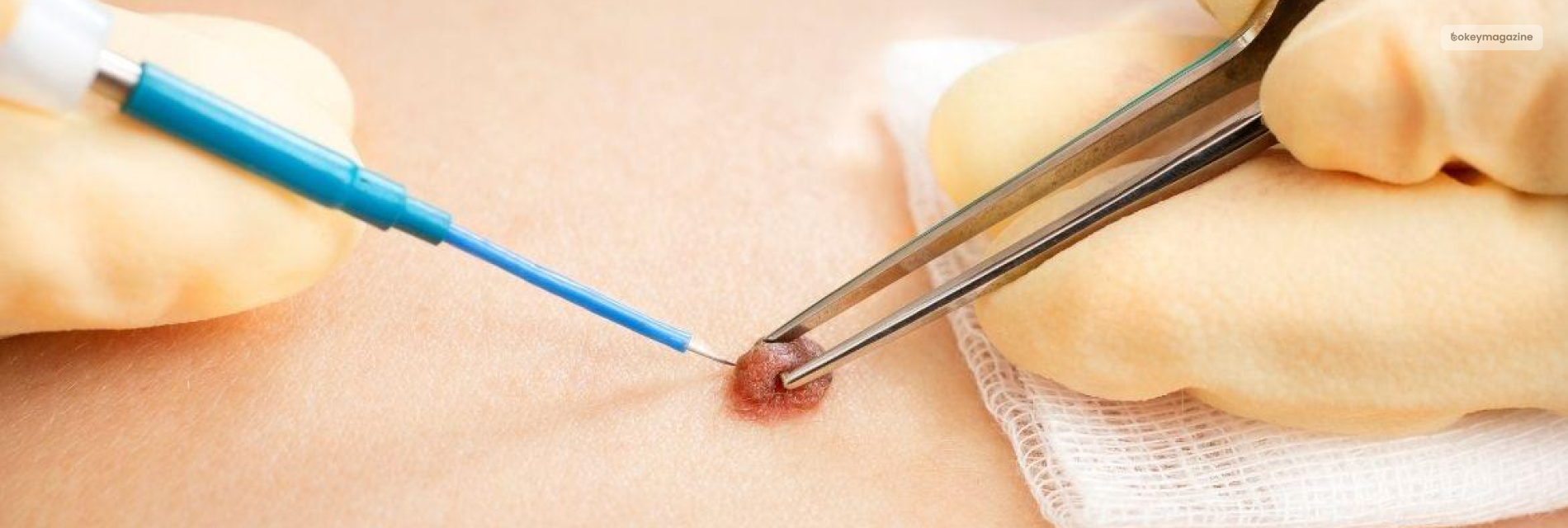 Mole Removal