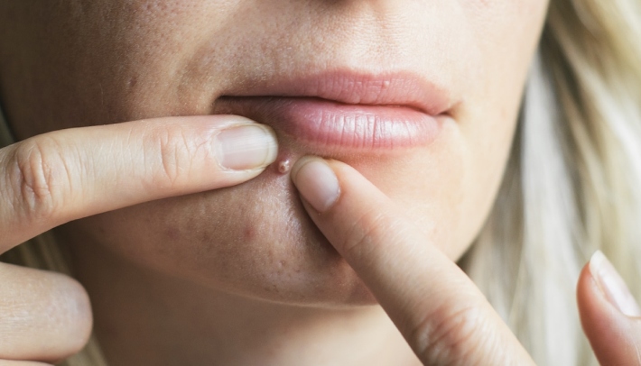 When Should You Leave The Pimple All Alone