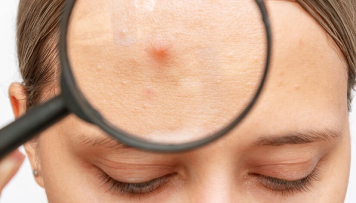 Different Types Of Zits On The Skin