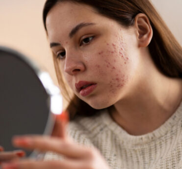 is niacinamide good for acne